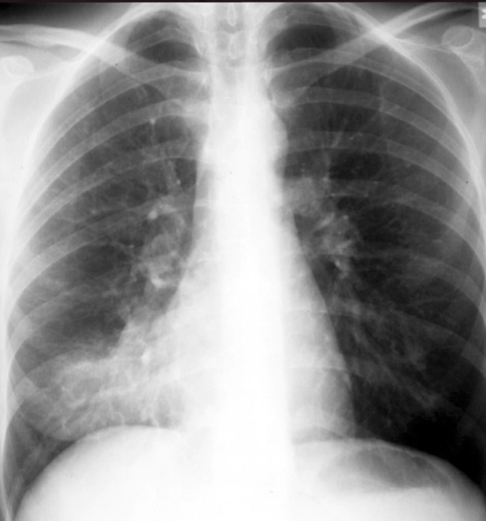 pneumonia of right middle lobe due to mycoplasma pneumoniae icd 10